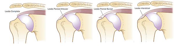 Sintomas e tratamento da lesão do manguito rotador