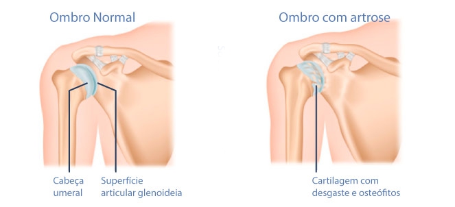 Artrose no ombro Tratamento de artrose no ombro médico ortopedista em campo grande