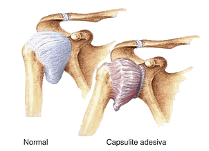 Capsulite adesiva ou ombro congelado tratamento ombro congelado