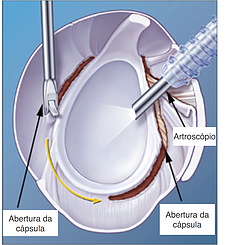Capsulite adesiva ou ombro congelado tratamento ombro congelado ou capsulite adesiva em Campo Grande