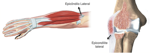 Epicondilite Lateral ou Cotovelo de Tenista tratamento Epicondilite Lateral ou Cotovelo de Tenista
