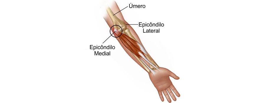 Cotovelo de golfista causa e tratamento da epicondilite medial ou cotovelo de golfista