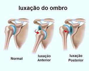 Luxação no ombro Tratamento Luxação do Ombro