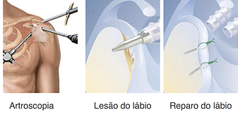 Luxação no ombro causas e tratamento da Luxação no ombro