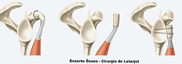 Luxação no ombro causas e tratamento da Luxação no ombro