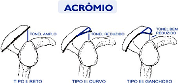 Bursite e Tendinite do Ombro Causas e tratamento da Tendinite e Bursite no ombro
