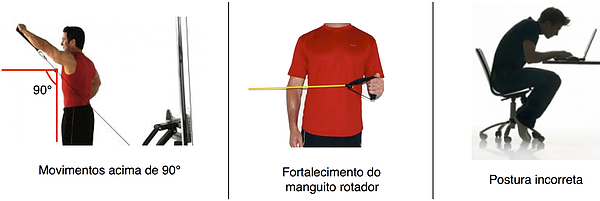 Bursite e Tendinite do Ombro Causas e tratamento da Tendinite e Bursite no ombro ou síndrome do Impacto
