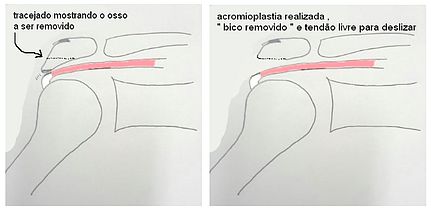 Bursite e Tendinite do Ombro Causas e tratamento da Tendinite e Bursite no ombro