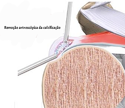 Tendinite Calcárea O que é Tendinite Calcárea: causas e tratamento